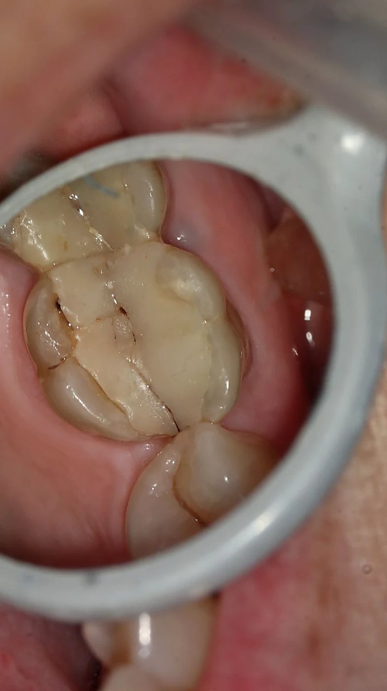Molar con caries profunda antes del tratamiento de conducto