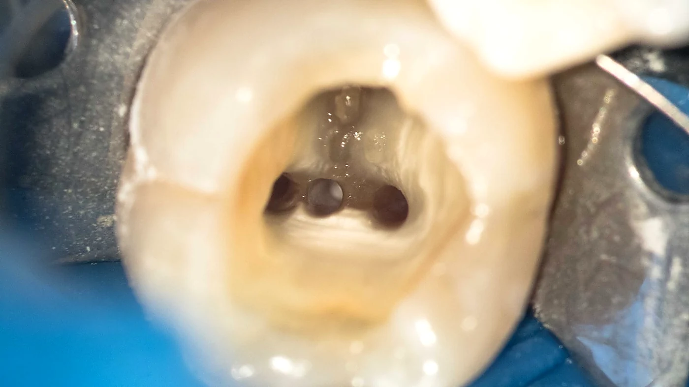 Conductos localizados bajo microscopio dental en Caracas