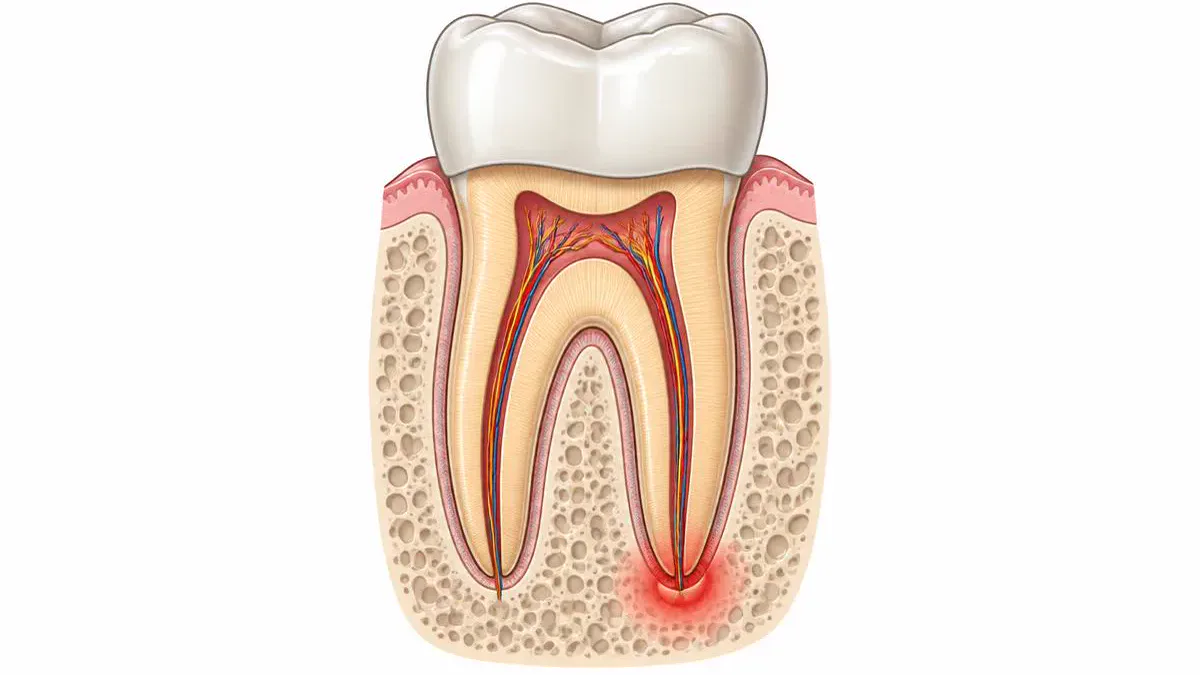 Ilustración de una muela con corona dental y una lesión alrededor de la raíz